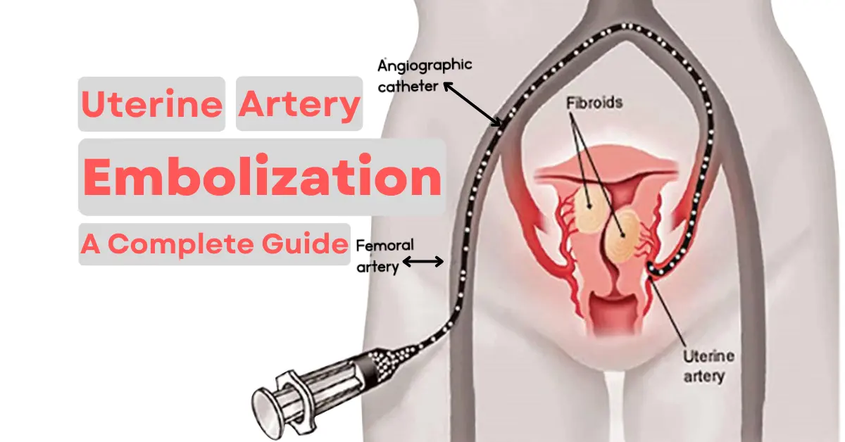 Uterine Artery Embolization A Complete Guide