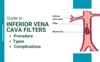 Guide to Inferior Vena Cava Filters