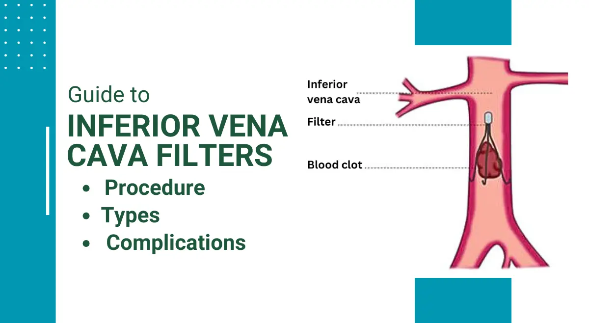 Guide to Inferior Vena Cava Filters: Procedure, Types, and Complications