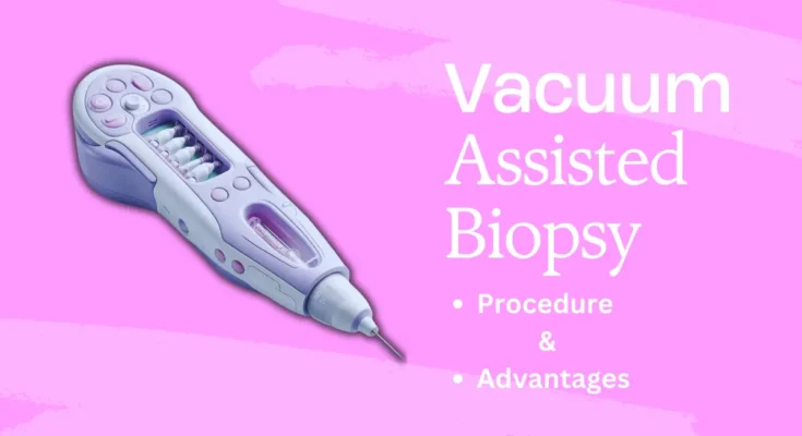 Understanding Vacuum-Assisted Biopsy