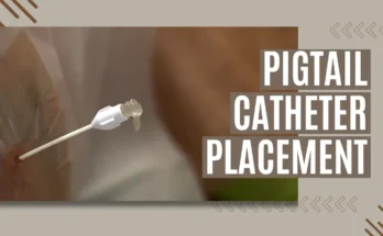 Pigtail Catheter Placement