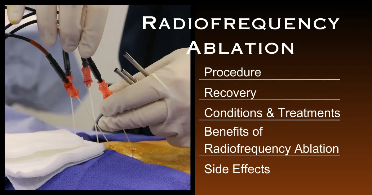 Radiofrequency Ablation: Procedure, Recovery, And Treatment