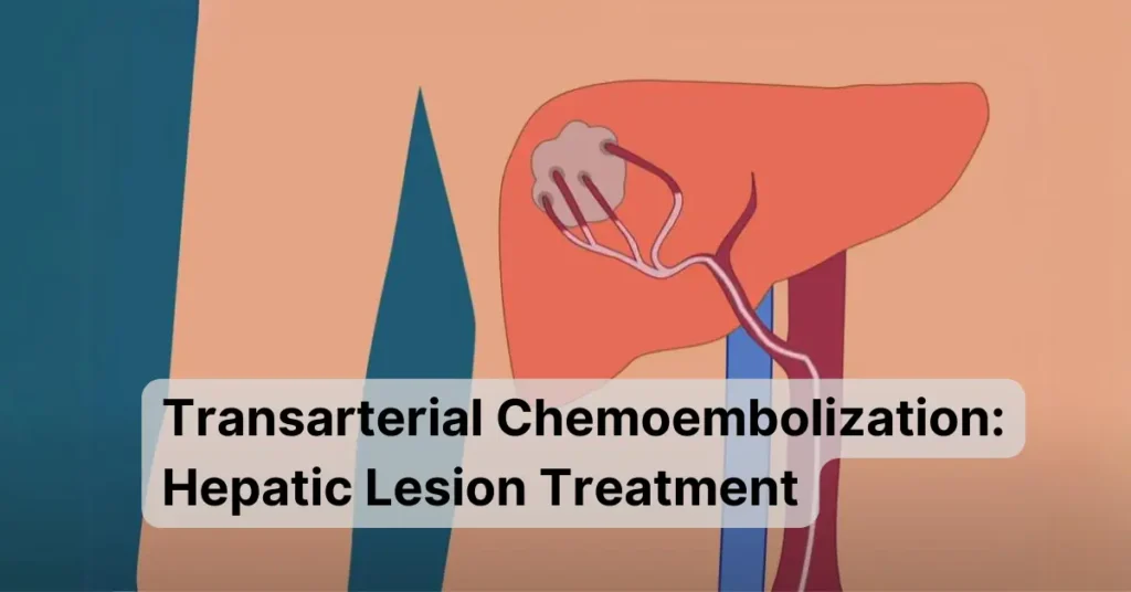 Transarterial Chemoembolization Hepatic Lesion Treatment