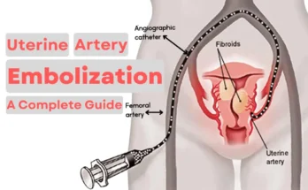 Uterine Artery Embolization – A complete Guide